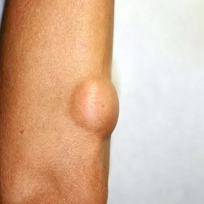 Lipoma Treatment in Dubai