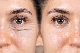 Eyelid Surgery in Dubai