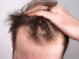 Hair Fall Treatment in Dubai