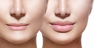 Lip Augmentation in Dubai