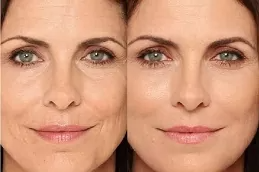 Liquid Facelift in Dubai