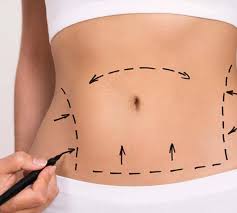 Tummy Tuck in Dubai