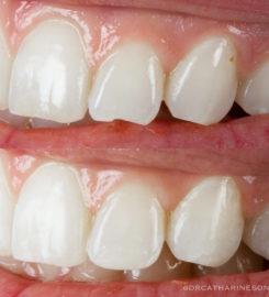 Song Cosmetic Dentistry Beverly Hills