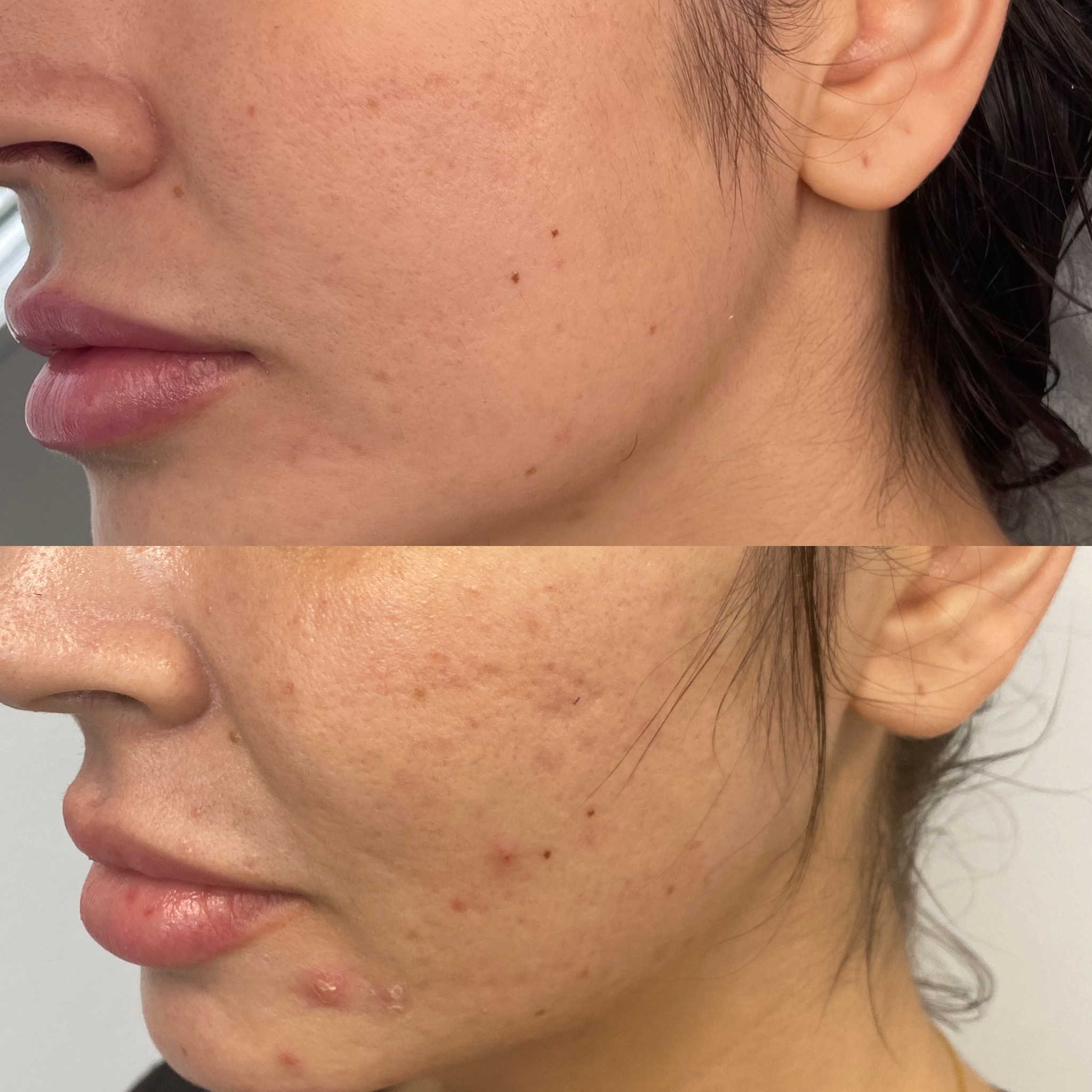 Skin Tightening, Botox and Lip Fillers by Skinsation LA