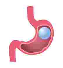 Gastric Balloon Cost in Dubai