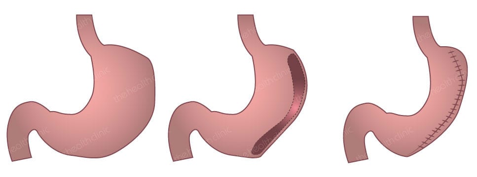Gastric Plication Dubai