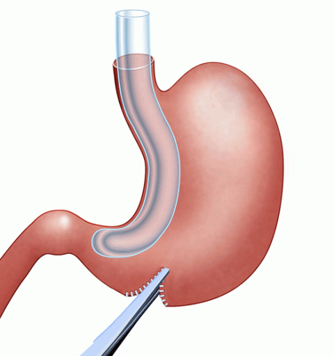 Gastric Sleeve Surgery in Dubai