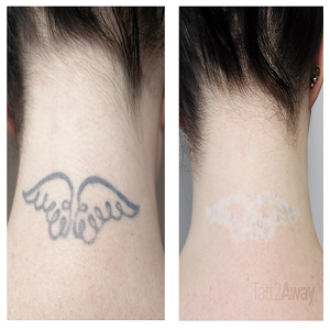 Tatt2Away® Huntington