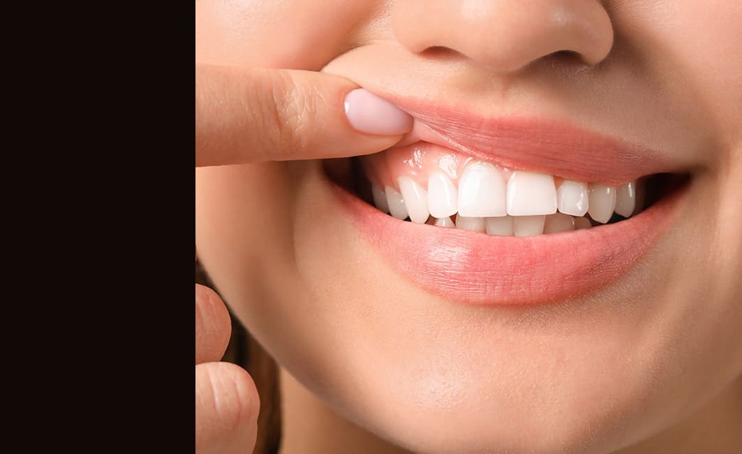 Gum Contouring Services in Sacramento