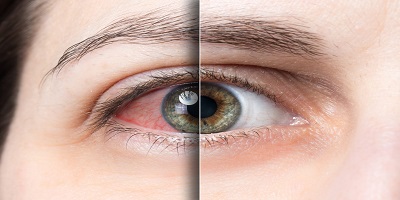 Dry Eye Treatment and Relief NJ