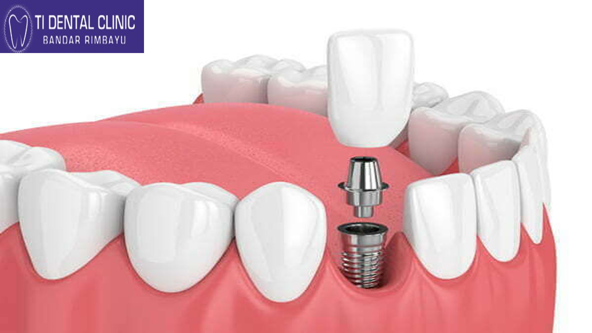 Ti Dental Clinic , Bandar Rimbayu