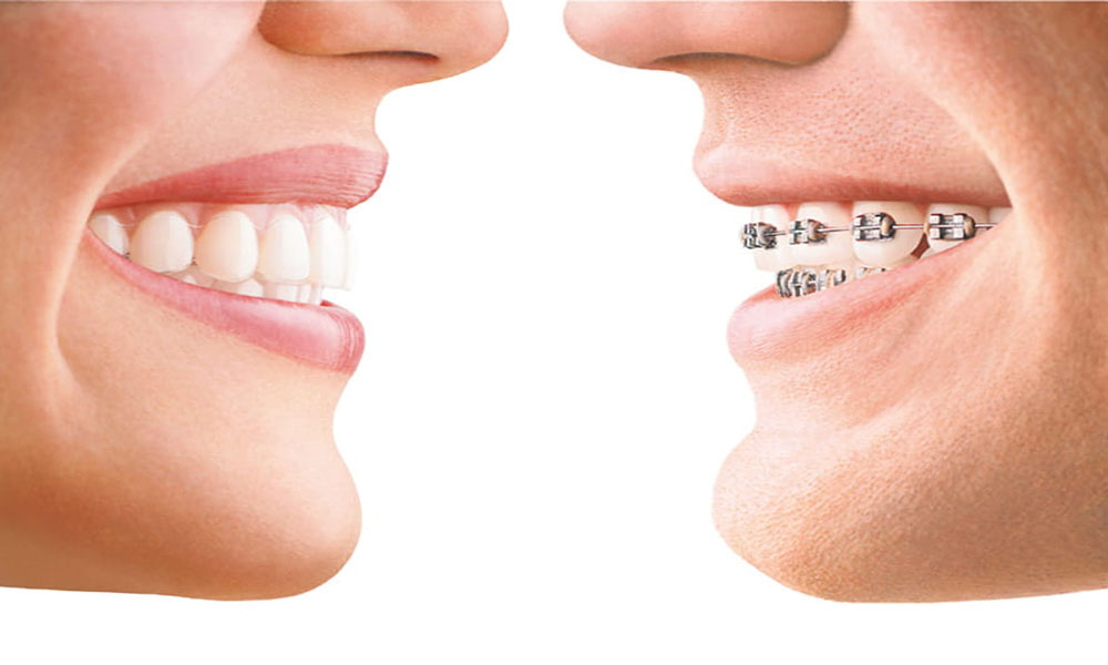 Invisalign In Chennai – Dr. Vishnu Priya M.D.S – Invi &hellip;