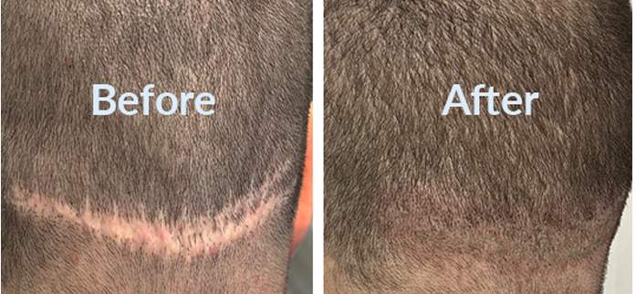 Ultra Scalp Micropigmentation