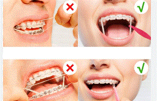 Latex Elastic Bands For Braces