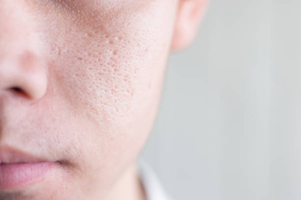 Large Pores Treatment in Islamabad, Rawalpindi, and Pakistan