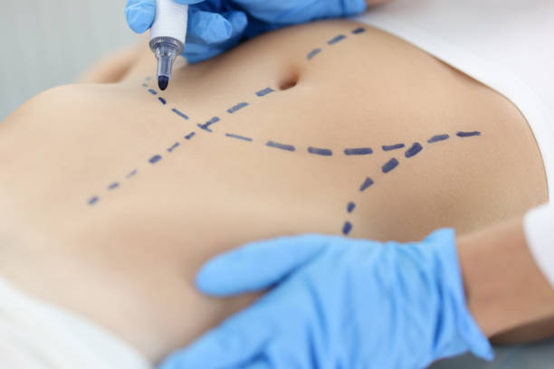 Liposuction in Islamabad, Pakistan