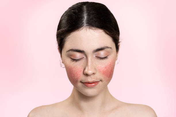 Rosacea treatment in Islamabad Pakistan