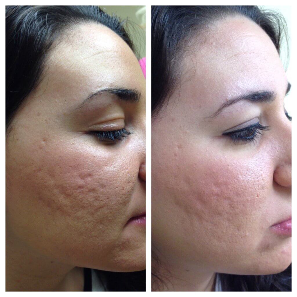 Microneedling treatment in Islamabad