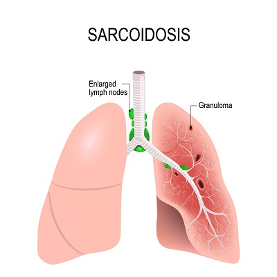 Best Allergic and Asthma Expert in Jaipur