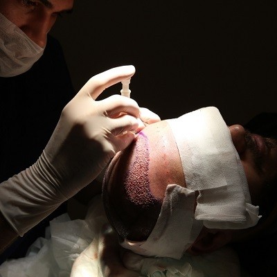 Hair Transplant in Islamabad.
