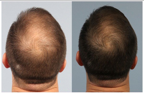 PRP Hair Treatment in Islamabad
