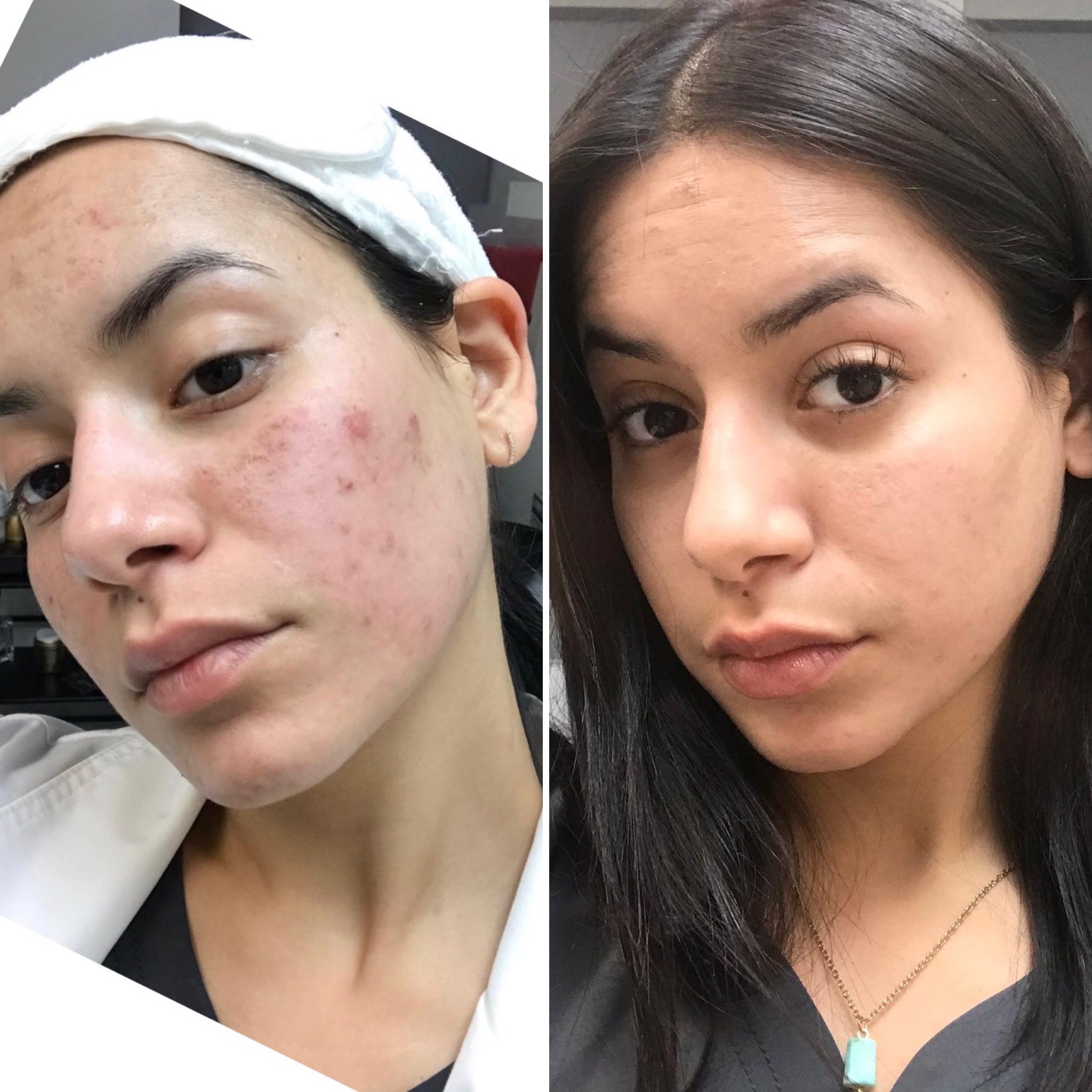 Micro needling treatment in Islamabad
