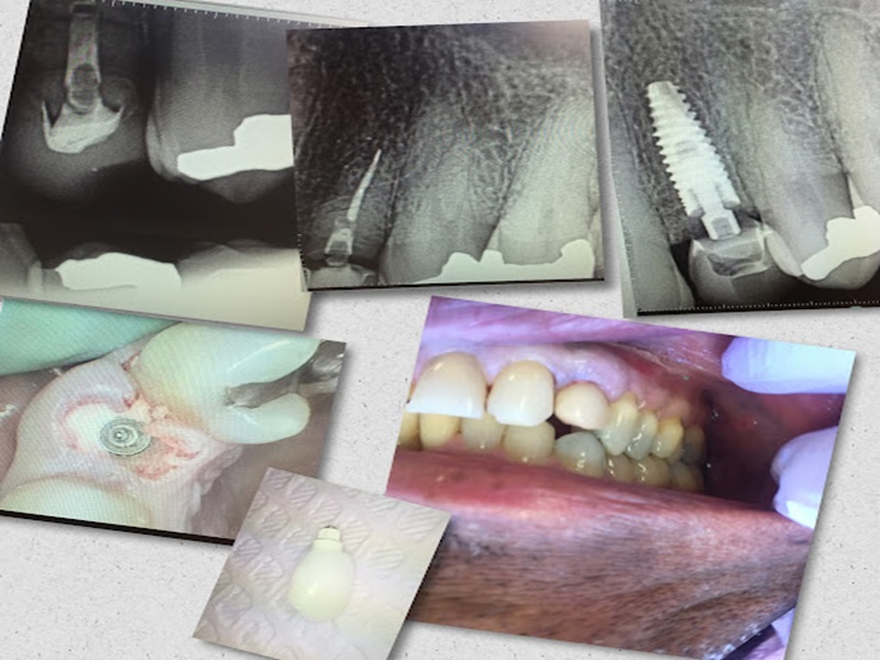 Central Valley Dentistry & Implants