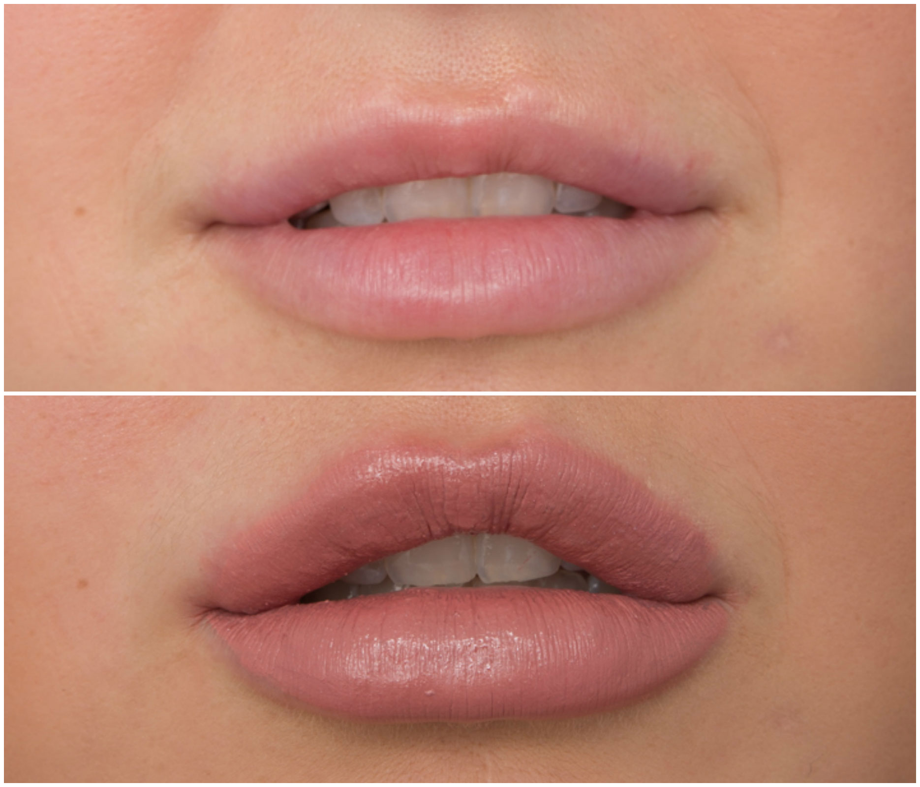 Lip augmentation in Islamabad-pk