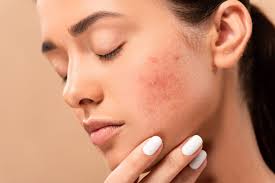 Acne Scars Treatment In Dubai