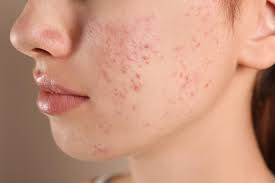 Acne Treatment In Dubai