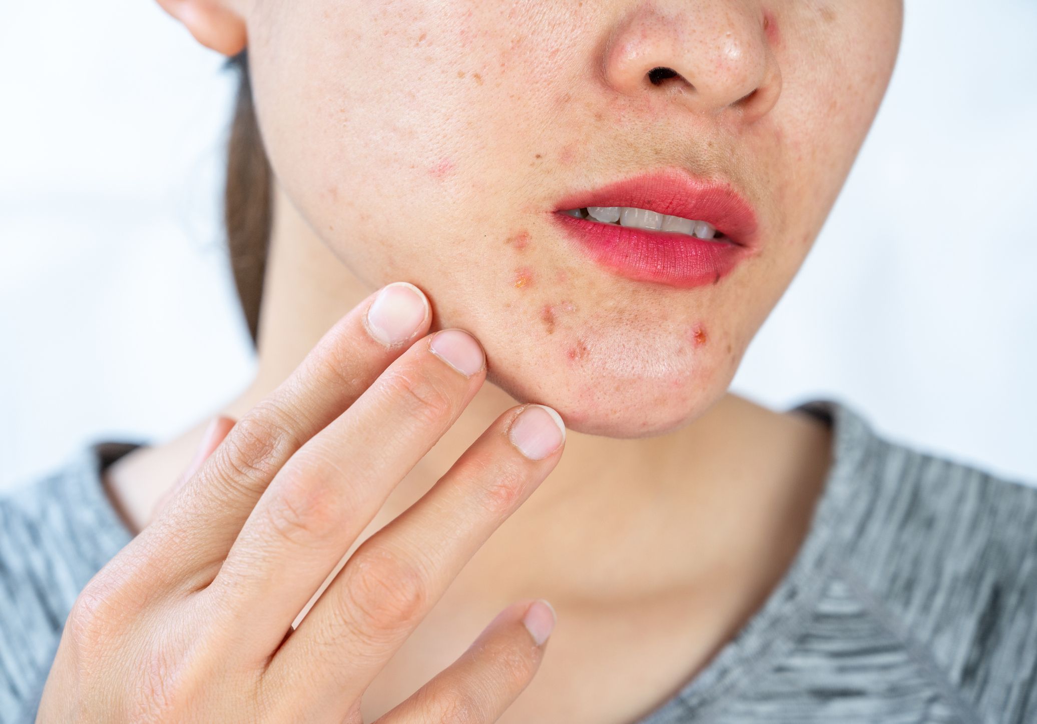 Pigmentation Treatment in Dubai