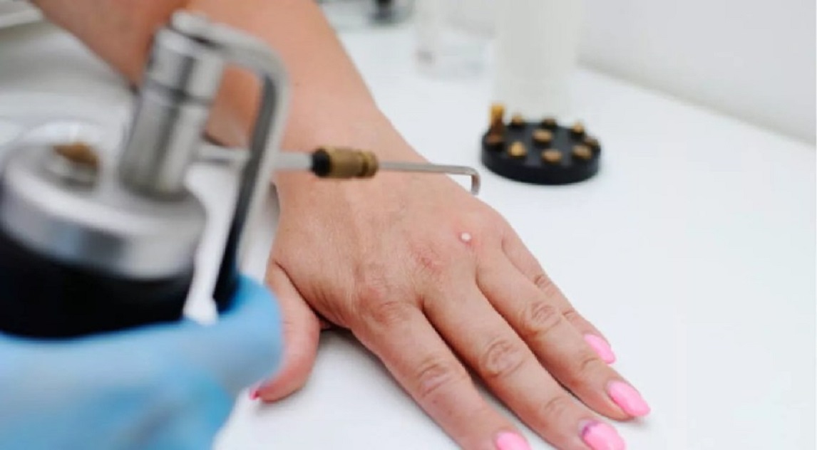 Warts Removal in Dubai