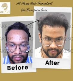 AKESO Hair Transplant