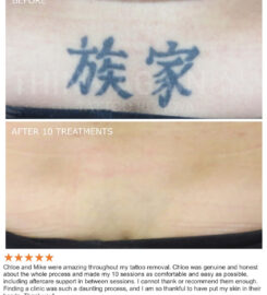 Think Again Tattoo Removal Austin