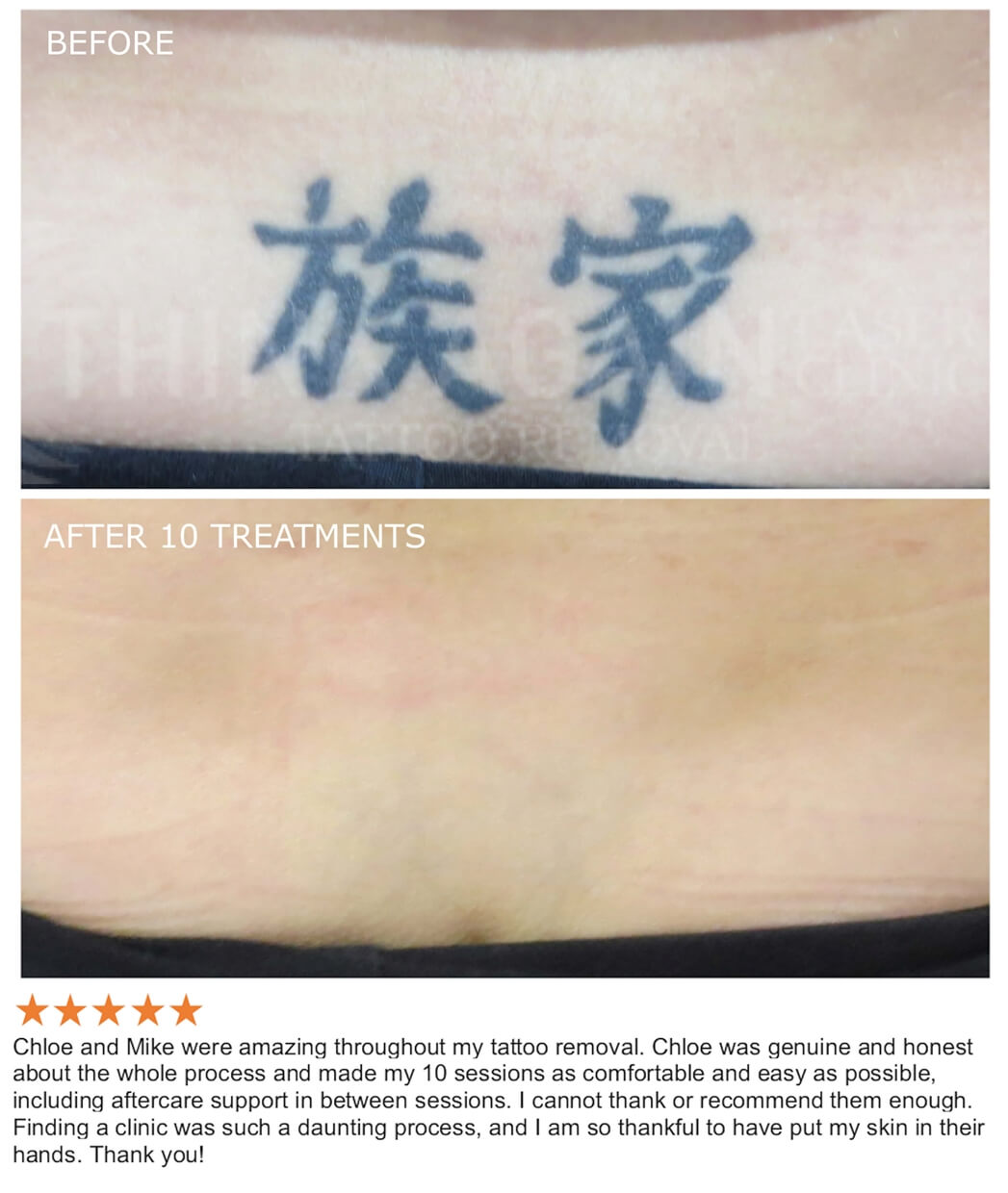 Think Again Tattoo Removal Austin