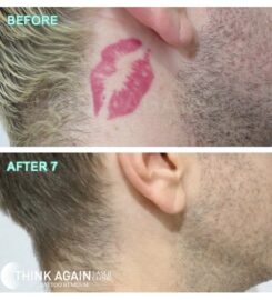 Think Again Tattoo Removal Austin