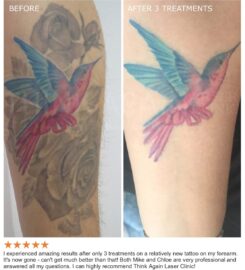Think Again Tattoo Removal Austin