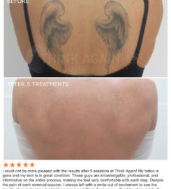 Think Again Tattoo Removal Austin