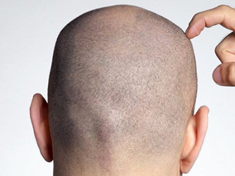 زراعة الشعر في دبي