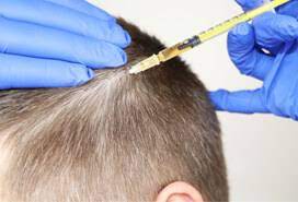 Hair Transplant In Islamabad