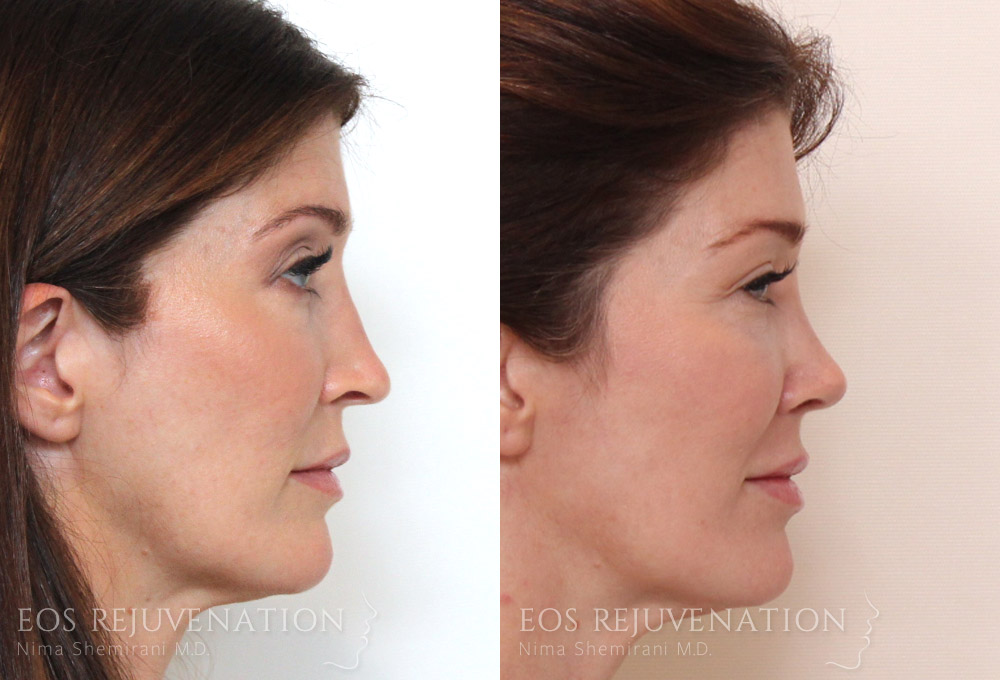 Eos Rejuvenation