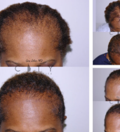 Linkov Hair Surgery