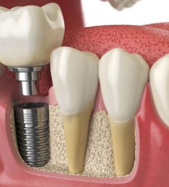 Cambrian Periodontics and Dental Implants