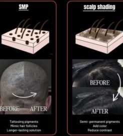 THE BLACK LIGHT — Scalp Micropigmentation (SMP)