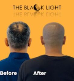 THE BLACK LIGHT — Scalp Micropigmentation (SMP)