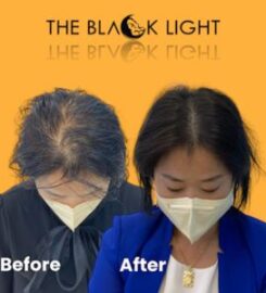 THE BLACK LIGHT — Scalp Micropigmentation (SMP)