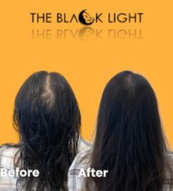 THE BLACK LIGHT — Scalp Micropigmentation (SMP)
