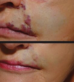 Distill Laser Clinic