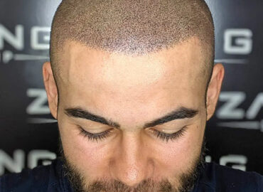 Zang SMP – Scalp Micropigmentation Los Angeles