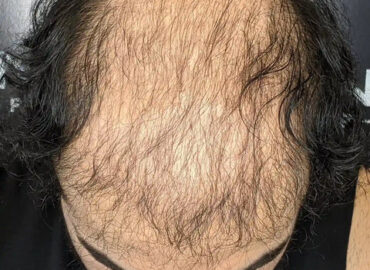 Zang SMP – Scalp Micropigmentation Los Angeles